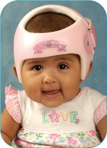 Cranial Remodeling Treatment,Your child has been referred for cranial remodeling treatment and will be fitted with a STARband™ cranial remodeling orthosis.- Image of baby girl wearing helmet